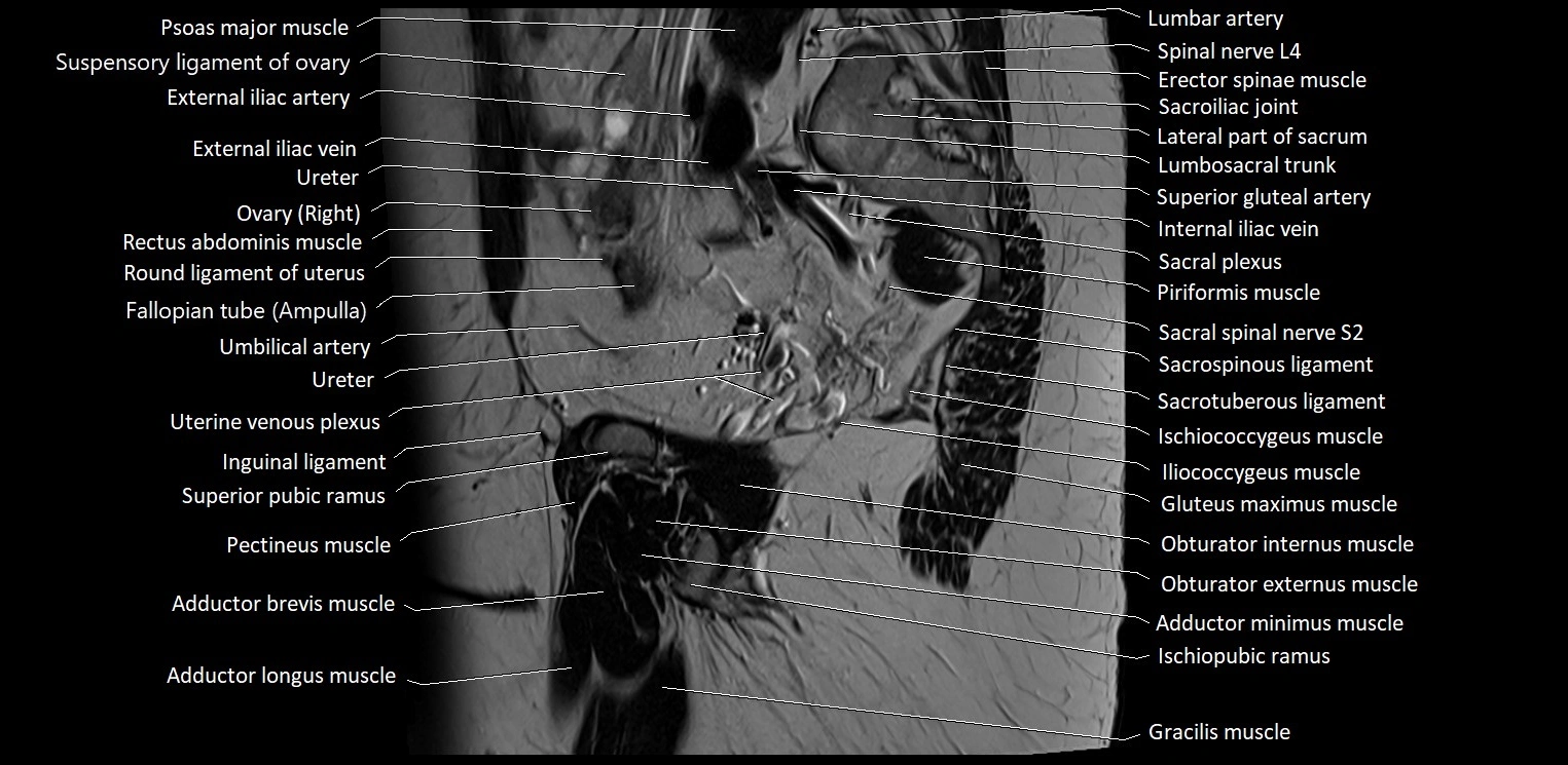Sagittal cross sectional anatomy of female pelvis (MRI 3T) image 11.webp